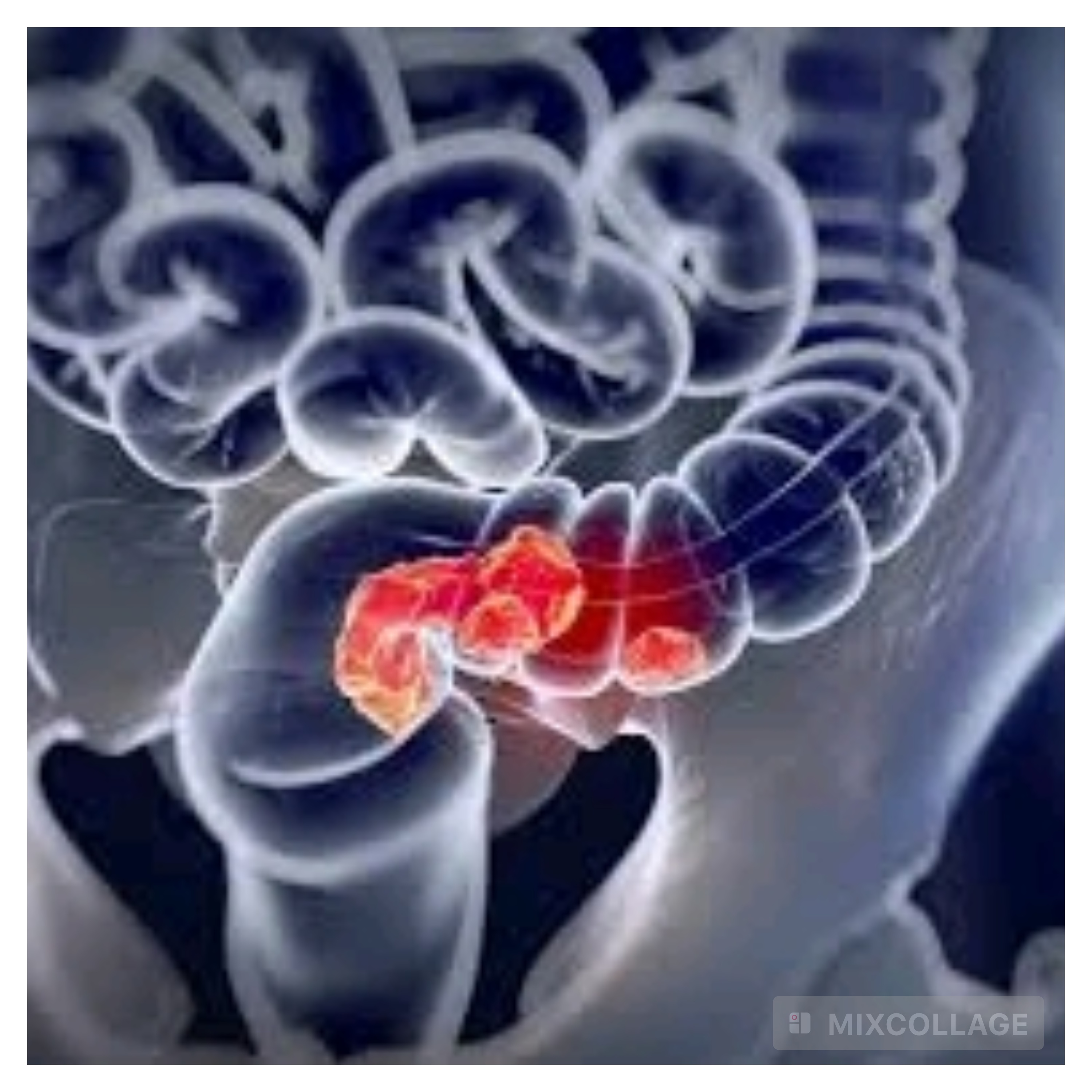 Tout savoir sur le cancer colorectal