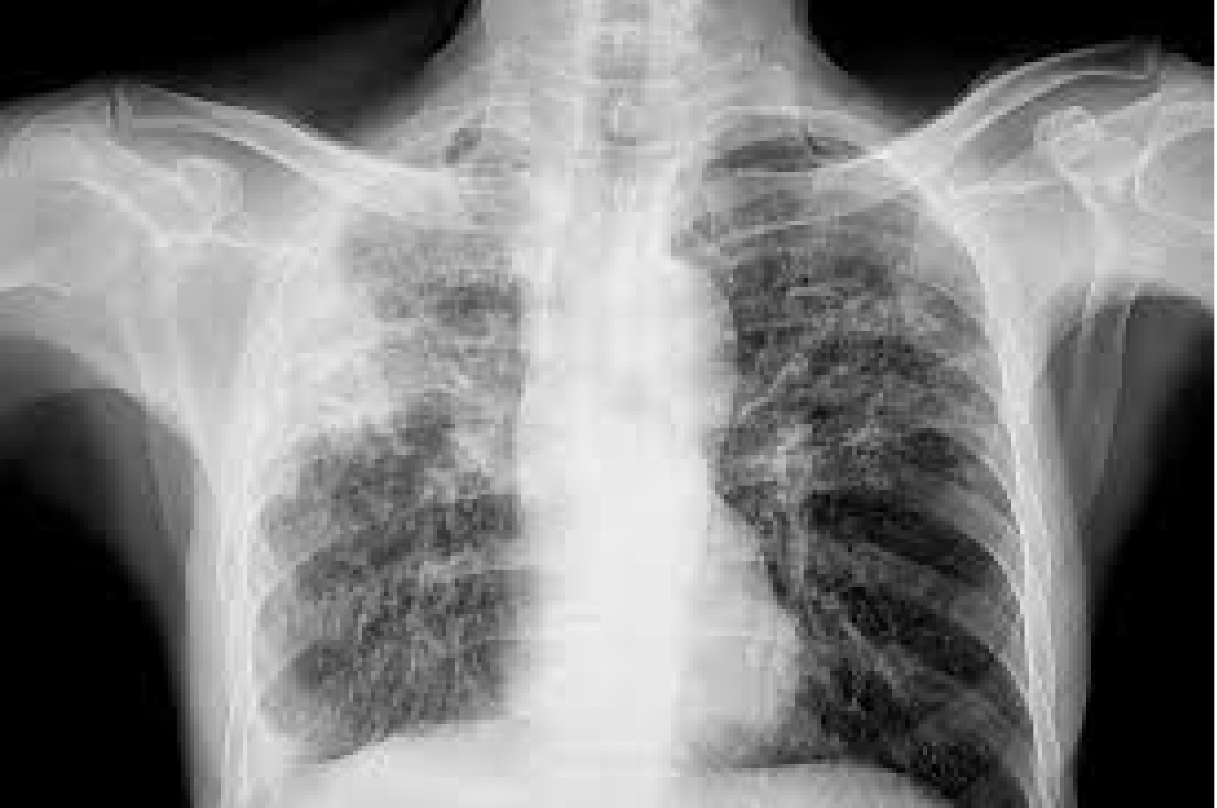 Pour mettre fin à la tuberculose